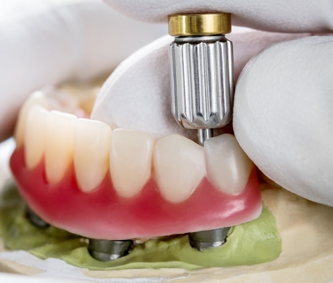 closeup-dental-implants-supported-overdenture-on-blue-background-screw-retained-implant-restorations